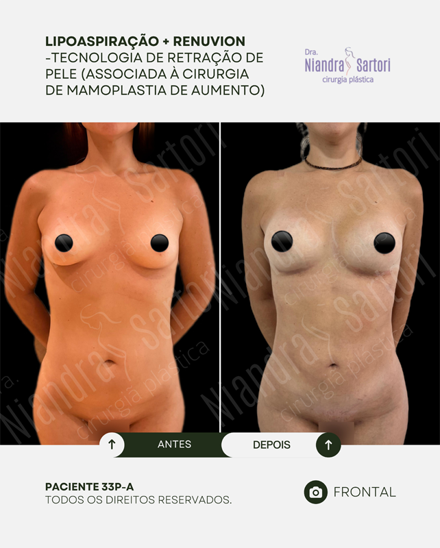 Lipoaspira&ccedil;&atilde;o + Renuvion, associada &agrave; mamoplastia de aumento