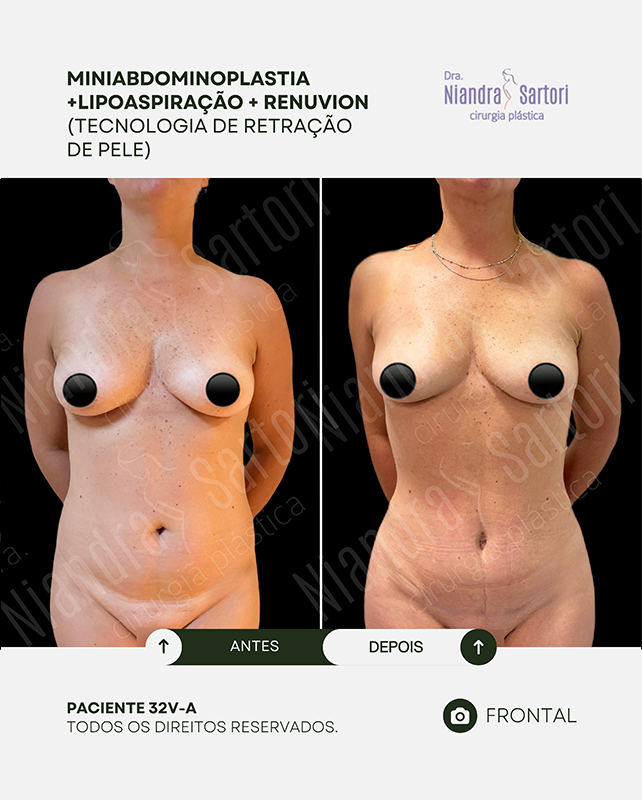 Miniabdominoplastia + Lipoaspira&ccedil;&atilde;o + Renuvion