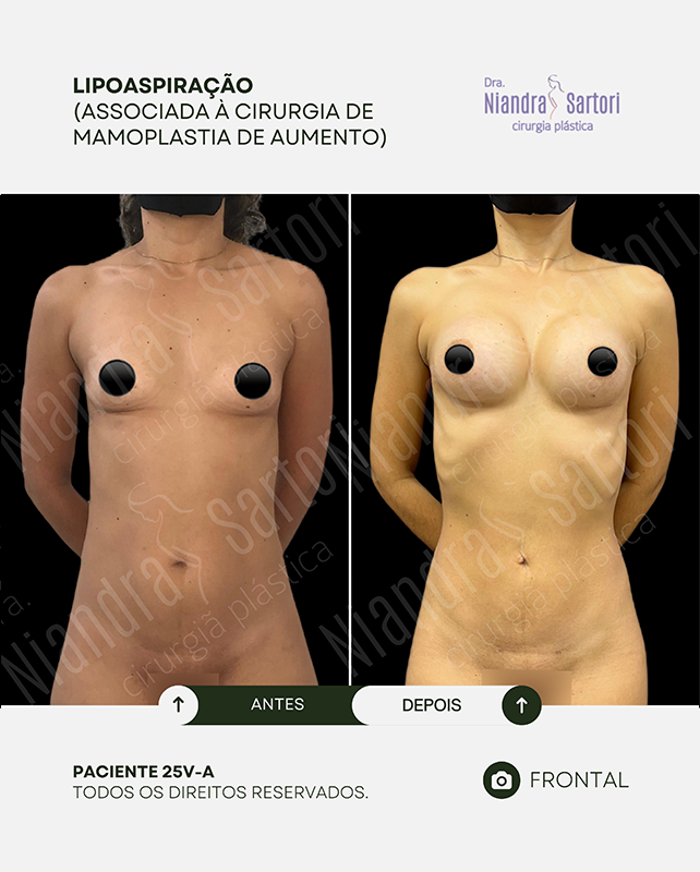 Lipoaspira&ccedil;&atilde;o, associada &agrave; mamoplastia de aumento