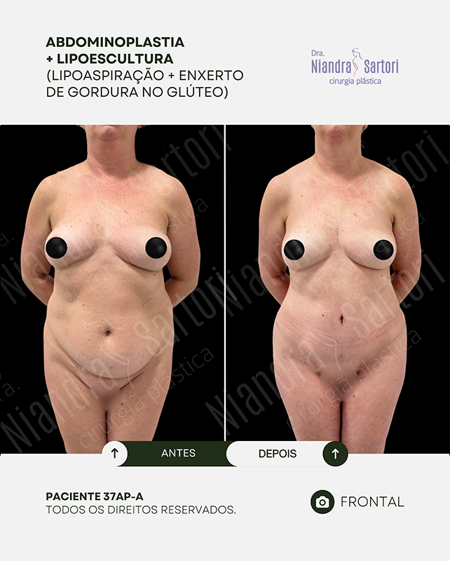 Abdominoplastia + Lipoescultura (Lipoaspira&ccedil;&atilde;o + enxerto de gordura no gl&uacute;teo)