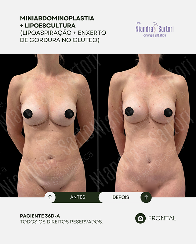 Miniabdominoplastia + Lipoescultura (Lipoaspira&ccedil;&atilde;o + enxerto de gordura no gl&uacute;teo)