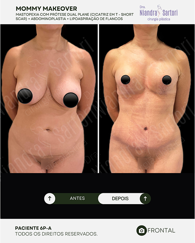 Mastopexia com pr&oacute;tese dual plane, cicatriz em T (short scar) + abdominoplastia + lipoaspira&ccedil;&atilde;o de flancos