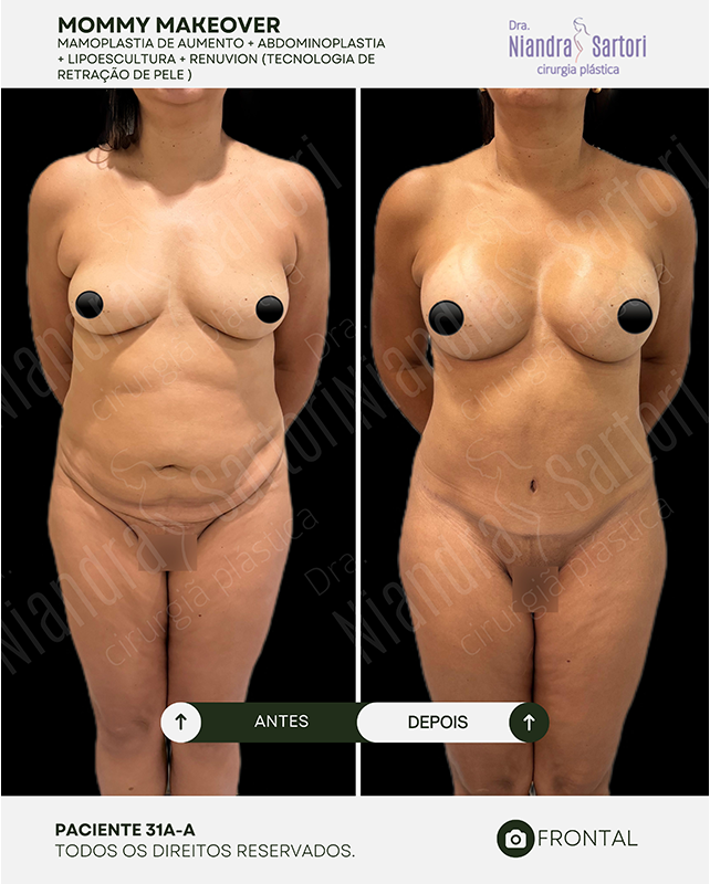 Mamoplastia de aumento + abdominoplastia + lipoescultura + Renuvion