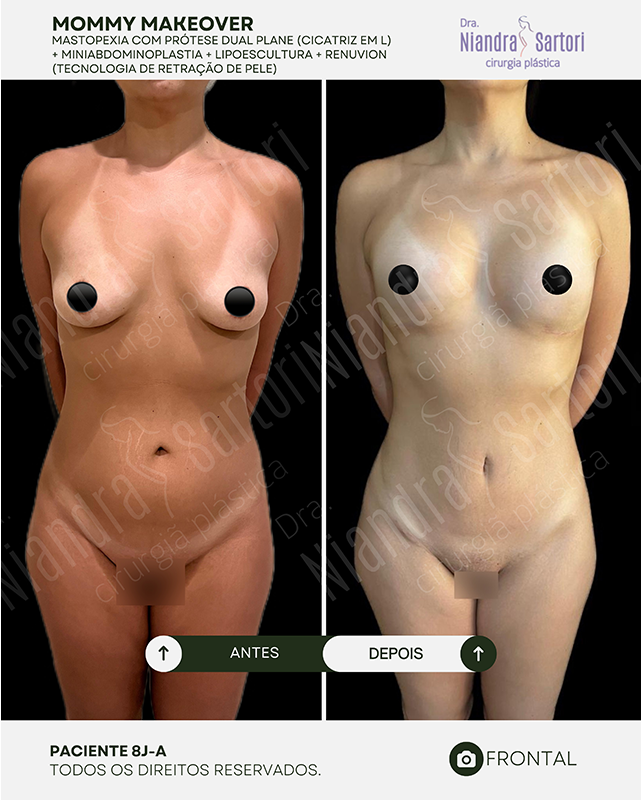 Mastopexia com pr&oacute;tese dual plane, cicatriz em L + miniabdominoplastia + lipoescultura + Renuvion