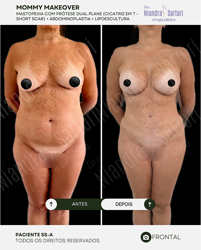 Mastopexia com pr&oacute;tese dual plane, cicatriz em T (short scar) + abdominoplastia + lipoescultura