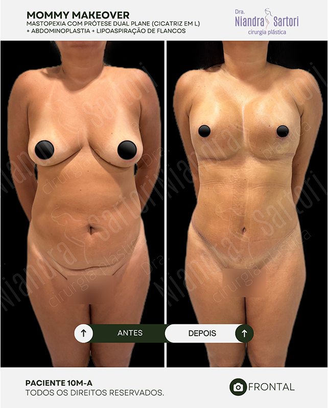 Mastopexia com pr&oacute;tese dual plane, cicatriz em L + abdominoplastia + lipoaspira&ccedil;&atilde;o de flancos