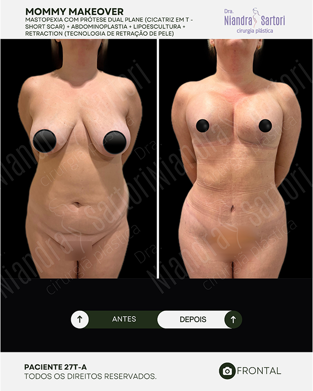 Mastopexia com pr&oacute;tese dual plane, cicatriz em T (short scar) + abdominoplastia + lipoescultura + Retraction