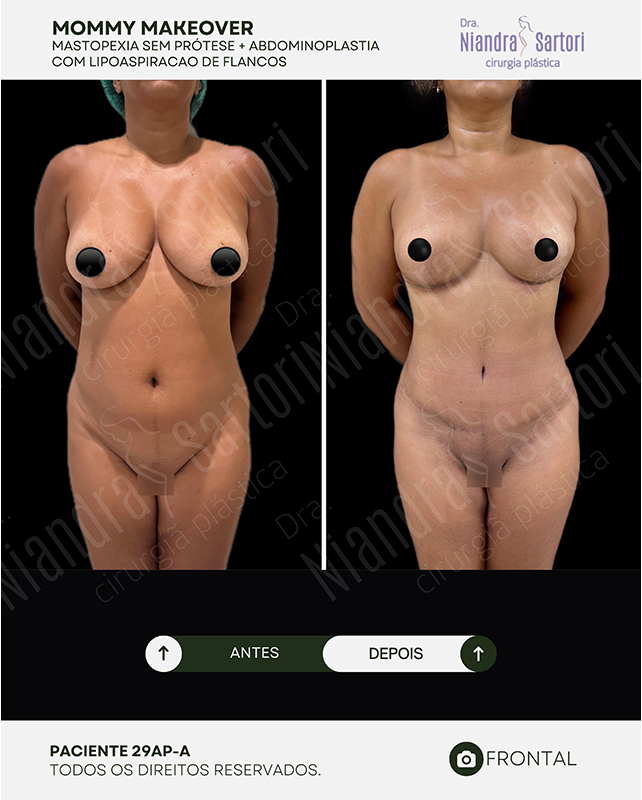 Mastopexia sem pr&oacute;tese + abdominoplastia com lipoaspira&ccedil;&atilde;o de flancos