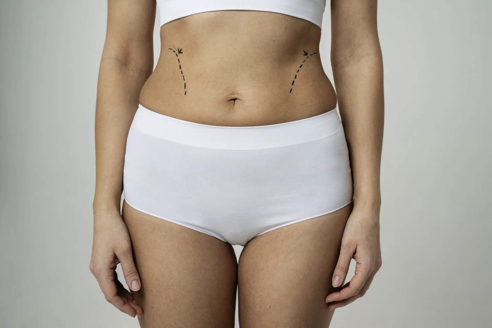 Referencia del contorno abdominal y de los flancos para la planificaci&oacute;n.