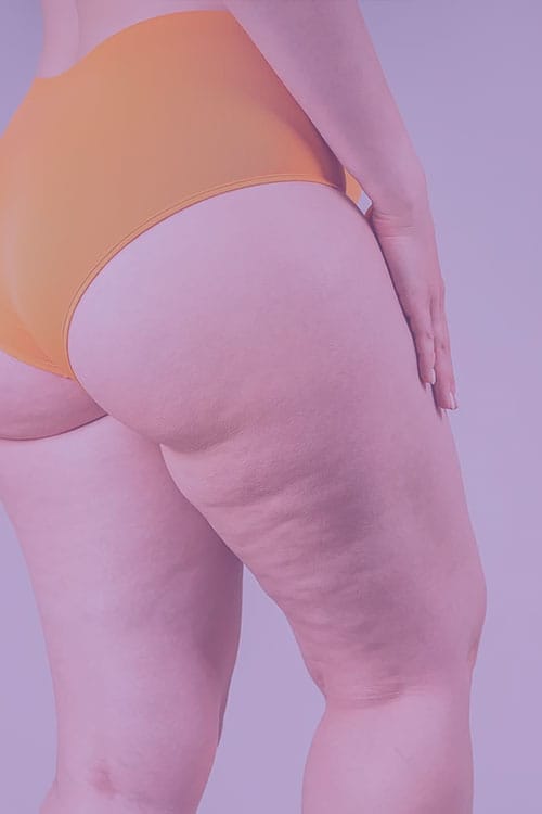 Lipedema