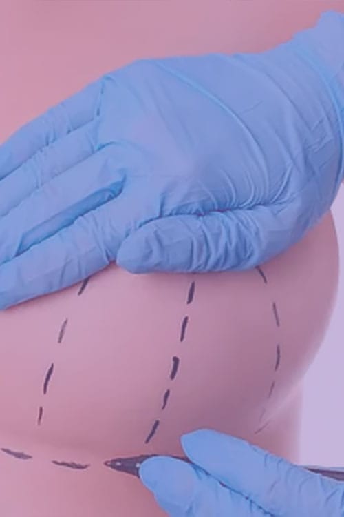 Mastopexia com cicatriz em L