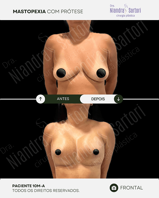 Mamas 3 Mamoplastia de aumento 1 copiar