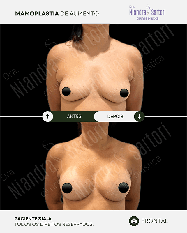Mamas 8 Mamoplastia de aumento 1