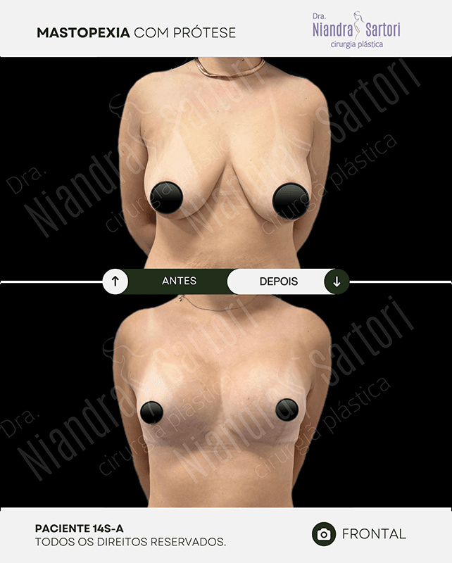 Mamas 5 NS PACIENTE 14S A 1