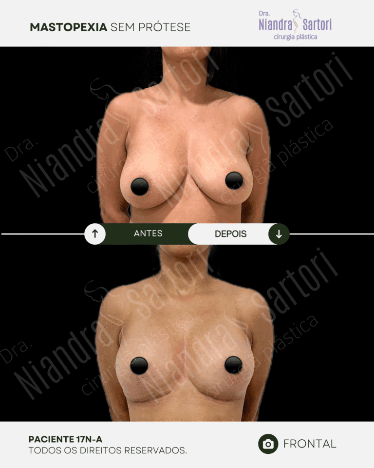 Mamas 16 NS_PACIENTE 17N-A