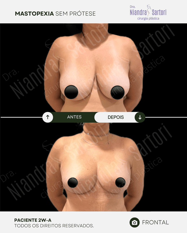 Mamas 7 NS PACIENTE 2W A 1