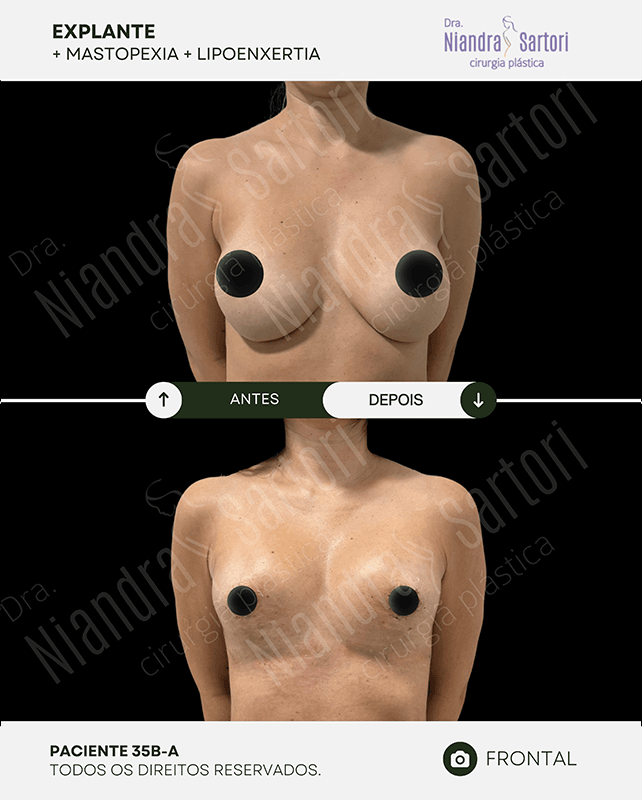 Mamas 10 NS PACIENTE 35B B 1