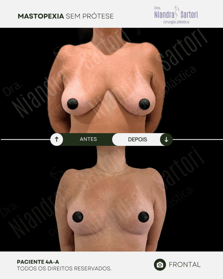 Mamas 14 NS_PACIENTE 4A-A