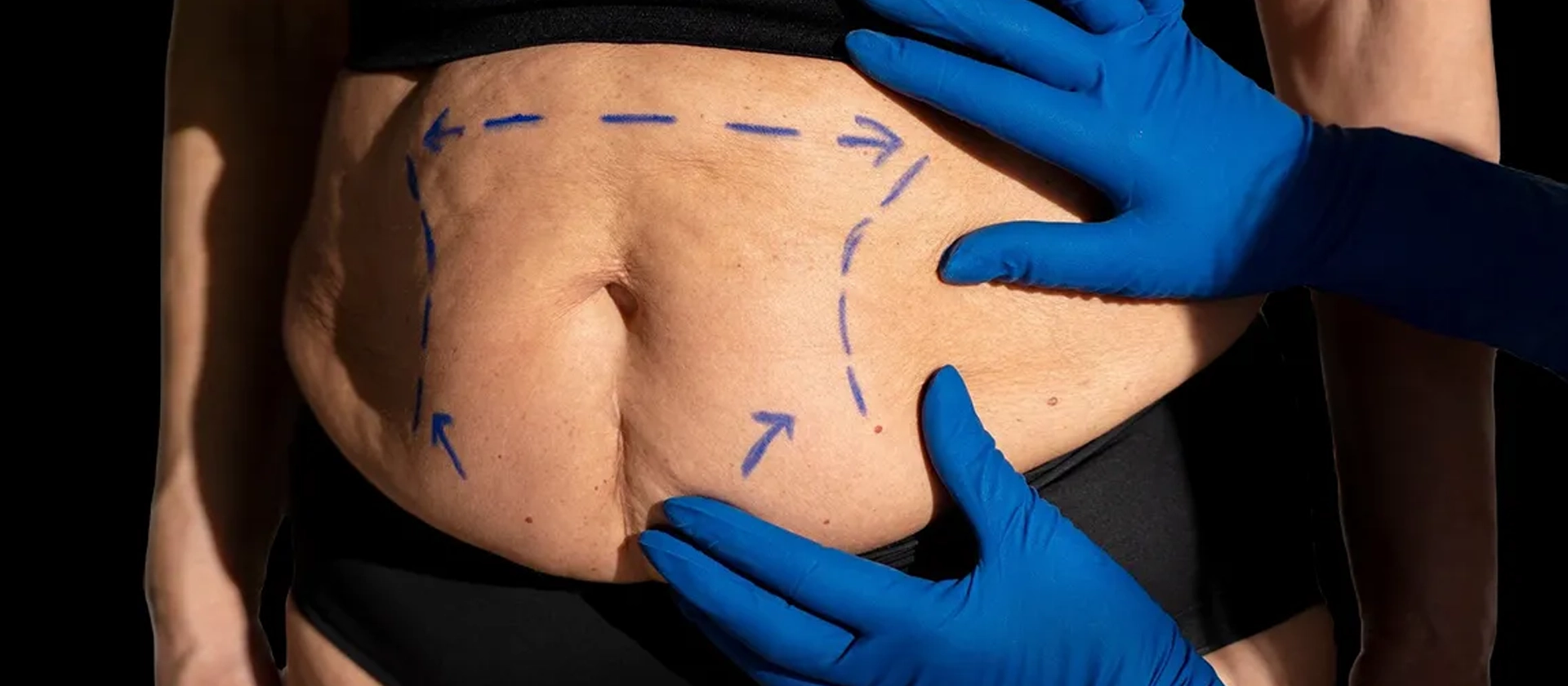 Blog 8 Abdominoplastia: flacidez abdominal tem solução